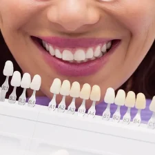 The Benefits of Porcelain Veneers