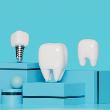 Dental Implants 101: The Only Guide You Need