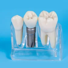 Dental Implants: The Long-Term Solution for Replacing Missing Teeth