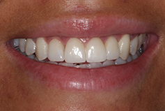 Smile Gallery - Patient After Treatment