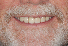 Smile Gallery - Patient After Treatment