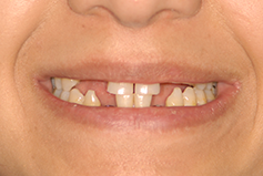 Smile Gallery - Patient Before Treatment