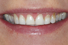 Smile Gallery - Patient Before Treatment
