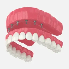 How Long Do Implant-Supported Dentures Last?