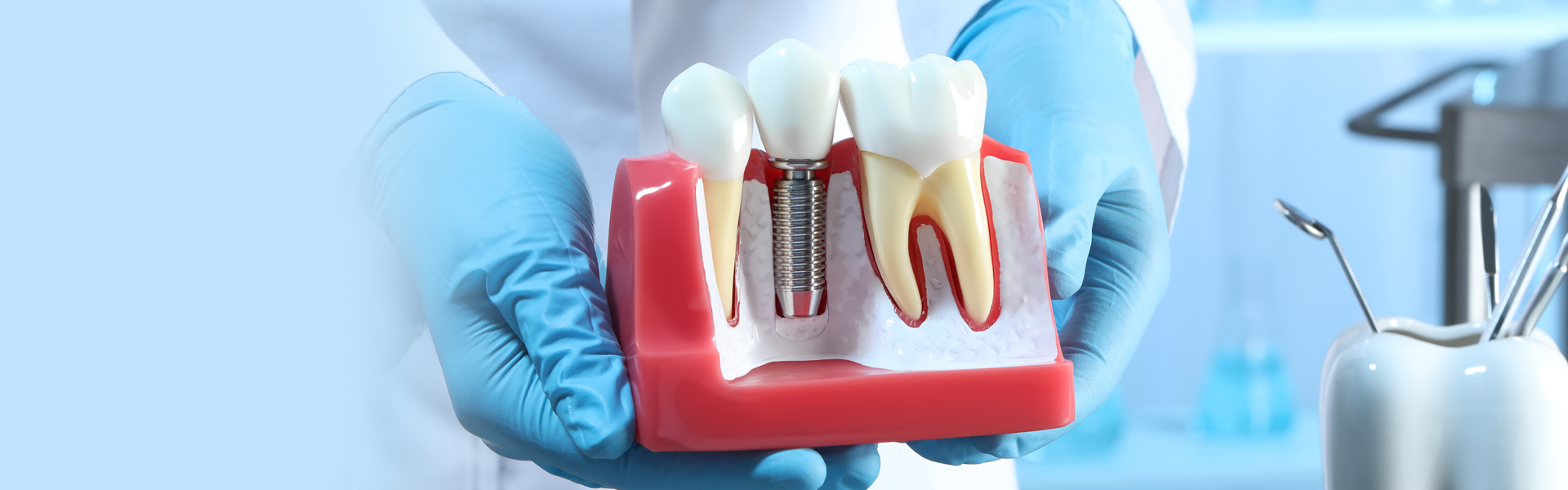 How Long After Pulling A Tooth Can You Get An Implant?