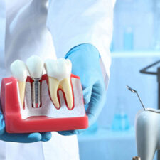 Dental Implants: A Closer Look at the Procedure and Benefits