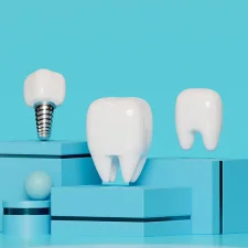 The Complete Guide to Dental Implants: What You Need to Know