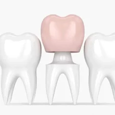 How Dental Crowns Restore Damaged Teeth to Perfection