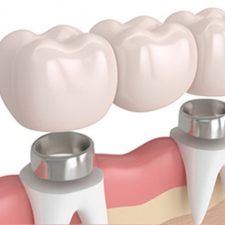 How Dental Crowns Restore Damaged Teeth to Perfection