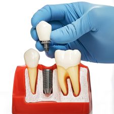 How Dental Implants Change Your Smile