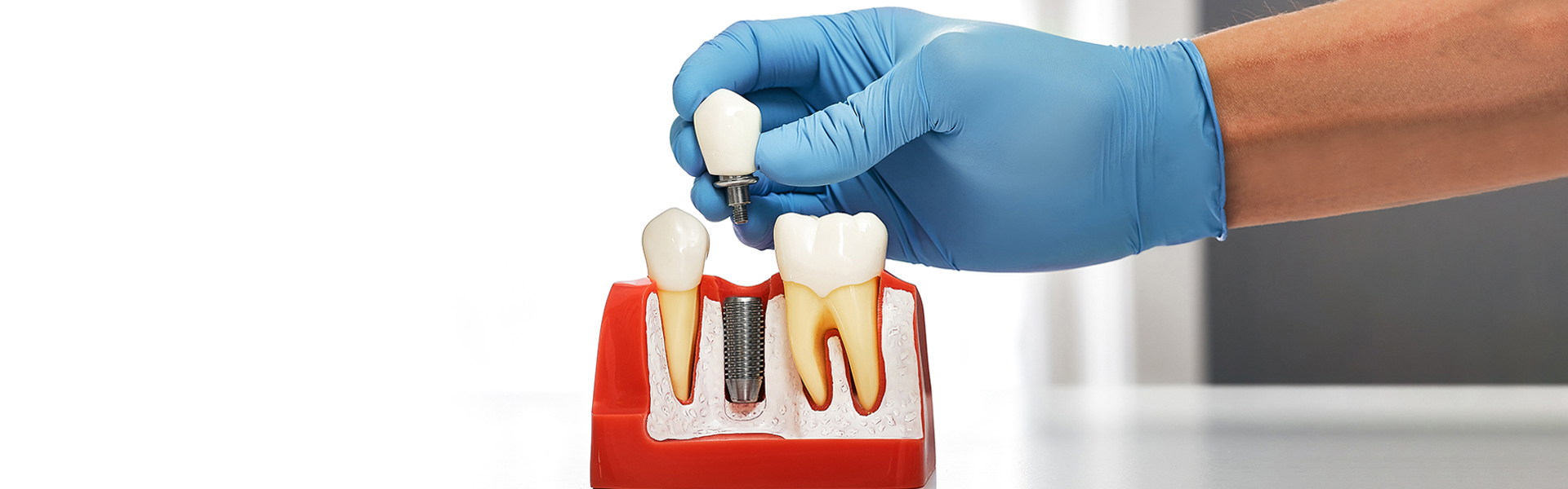 How Dental Implants Change Your Smile
