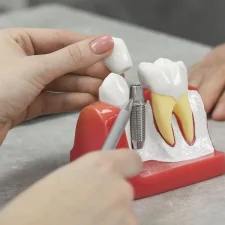 How Long Do Dental Implants Last