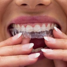 Clear Aligners in Calgary, AB: How Do They Work